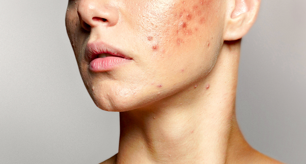 The 5 Sorts of Pimples Scars and How Progressive Topical Antibiotics Like Vitastem Can Deal with & Heal Pimples 10x Extra Successfully